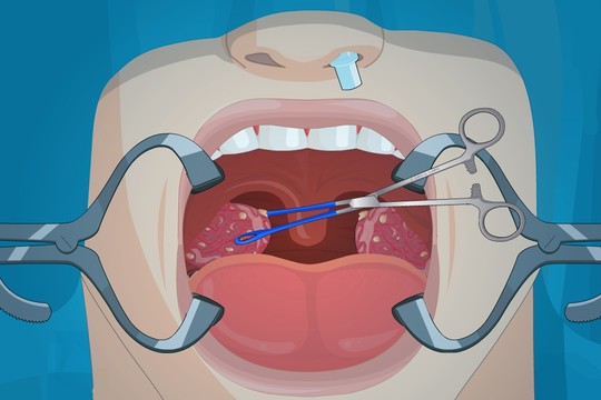 Operate Now: Tonsil Surgery图片1