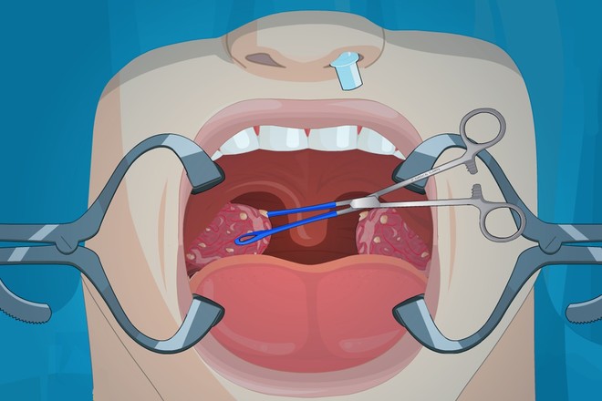 Operate Now: Tonsil Surgery截图4